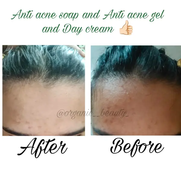 Anti-Acne Facewash | Natural Tea Tree & Neem Cleanser for Clear, Healthy Skin - Image 2